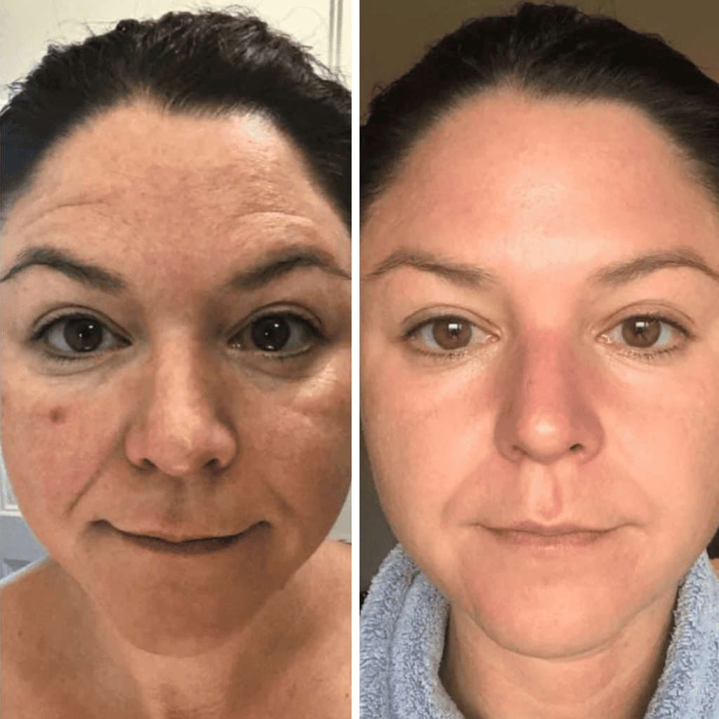 Patchs Hydrogel à l'Aloe Vera, Lutte Contre les Cernes et Rides autour des Yeux