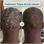 Charger l'image dans la galerie, Savon Bio Antifongique __ Efficace contre les infections cutanées
