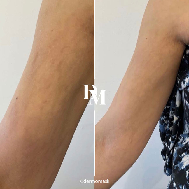 Huile Naturelle Anti Vergetures et Taches Noires