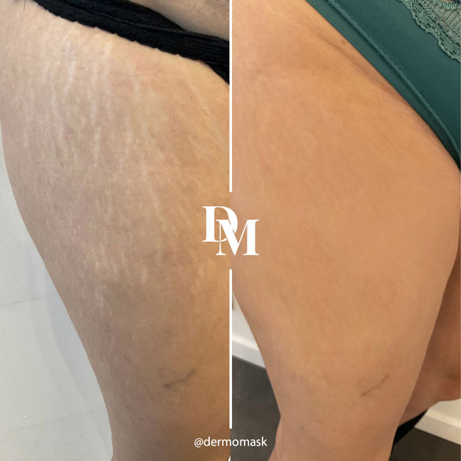 Huile Naturelle Anti Vergetures et Taches Noires